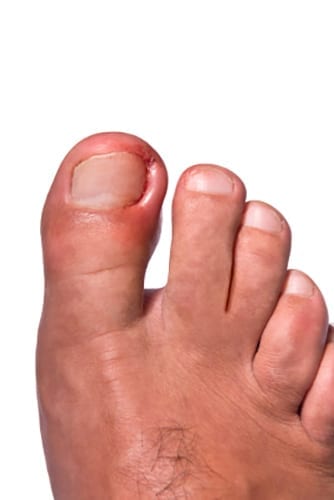 ingrown toe nail being treated at Spine Sports Feet clinic in Helensvale
